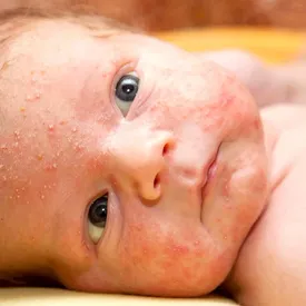 آخرین آمار ابتلا به سرخجه در کشور