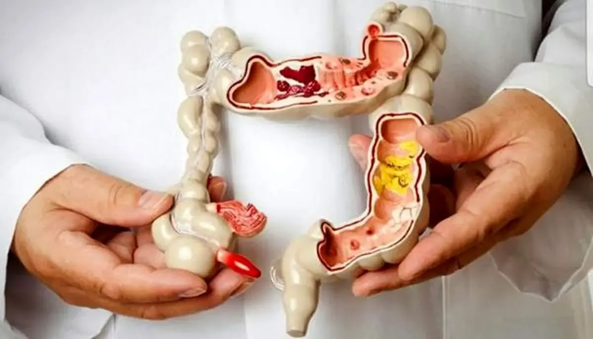 چند نکته خوب در مورد سرطان معده