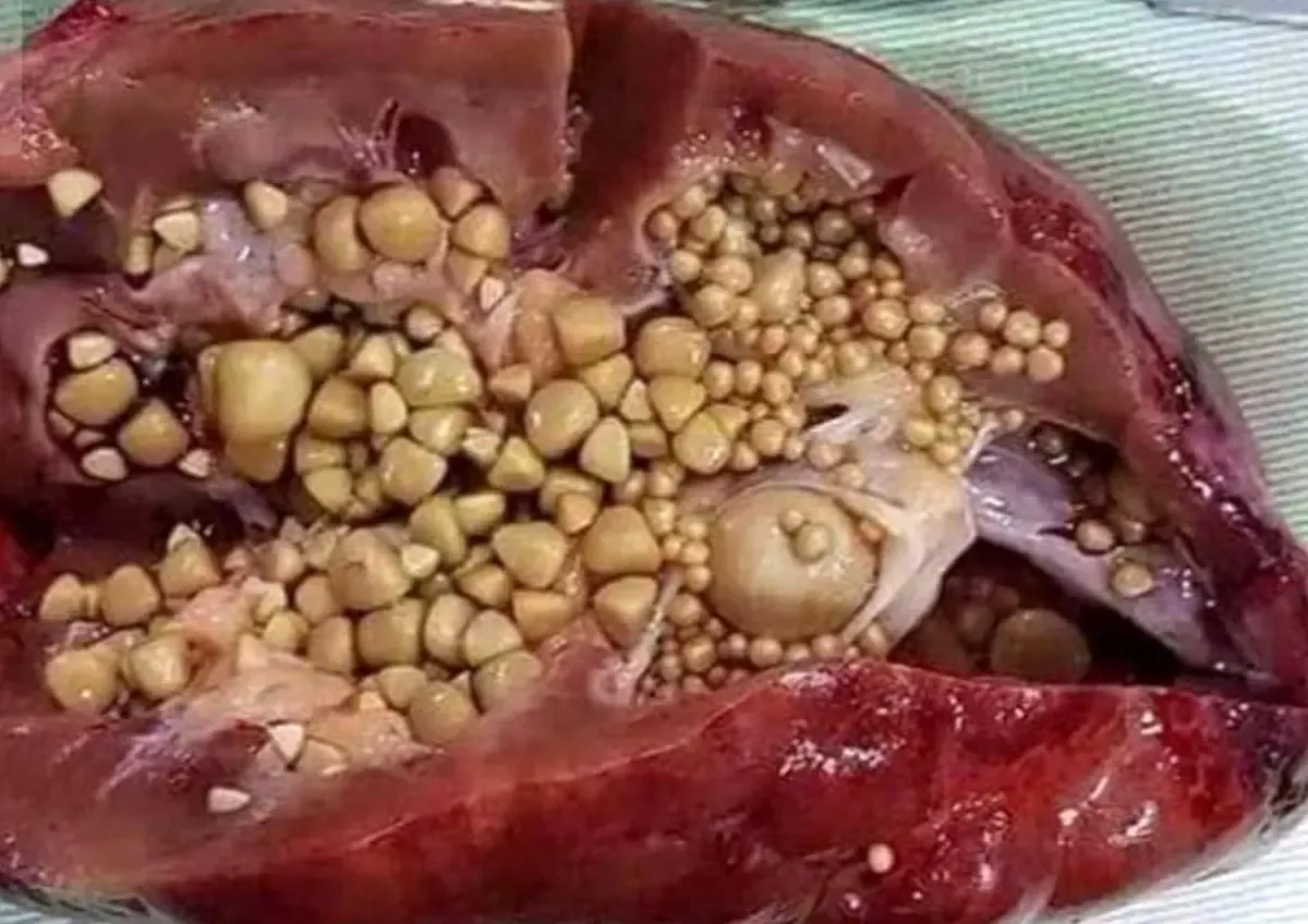 نشانه های سنگ کلیه را بشناسید