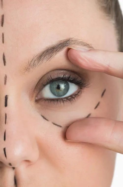 بلفاروپلاستی بانوان