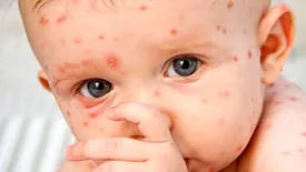 آبله مرغان در بهار به کمین کودکان می نشیند