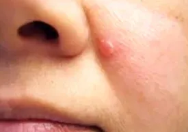 کدام جوشها علامت سرطان پوست است؟