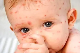 ابتلای کودکان به آبله مرغان خطرناک است؟
