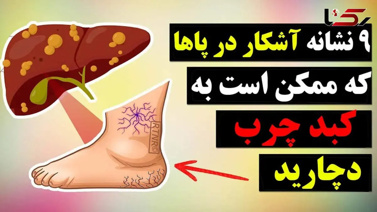 ببینید / تشخیص کبد چرب از روی ظاهر پا