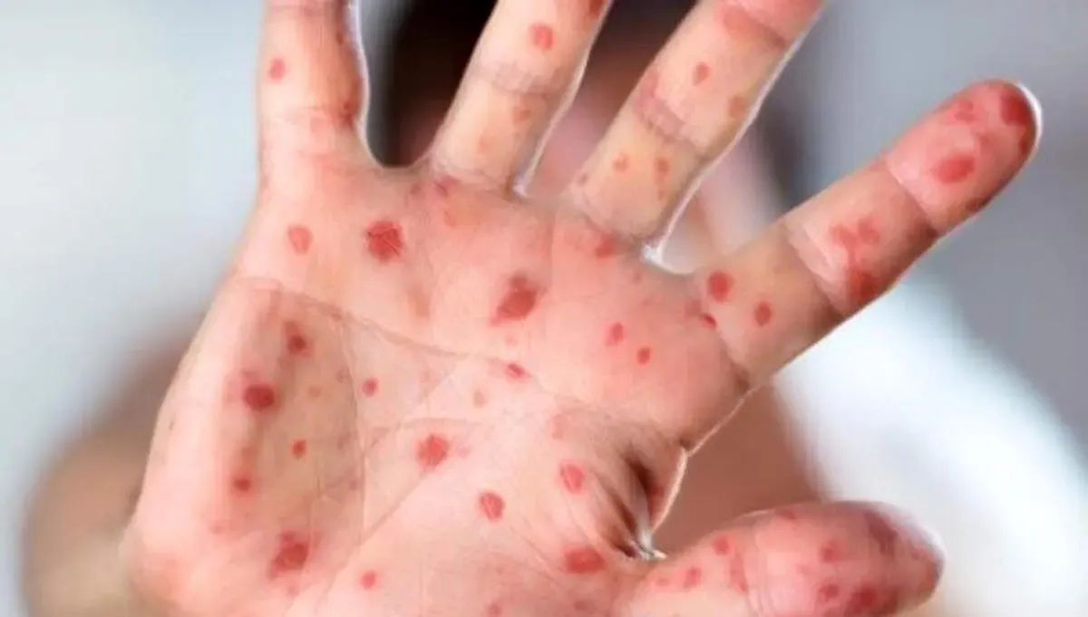 این بیماری ۲۹ نفر را در بابل روانه بیمارستان کرد