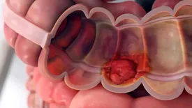 مصرف بیش از حد این غذاها روده شما را سرطانی می کند