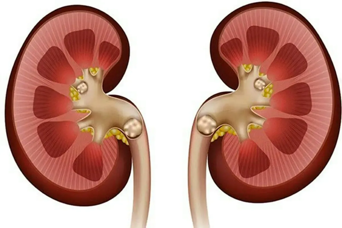 عادات مضر برای کلیه‌ها