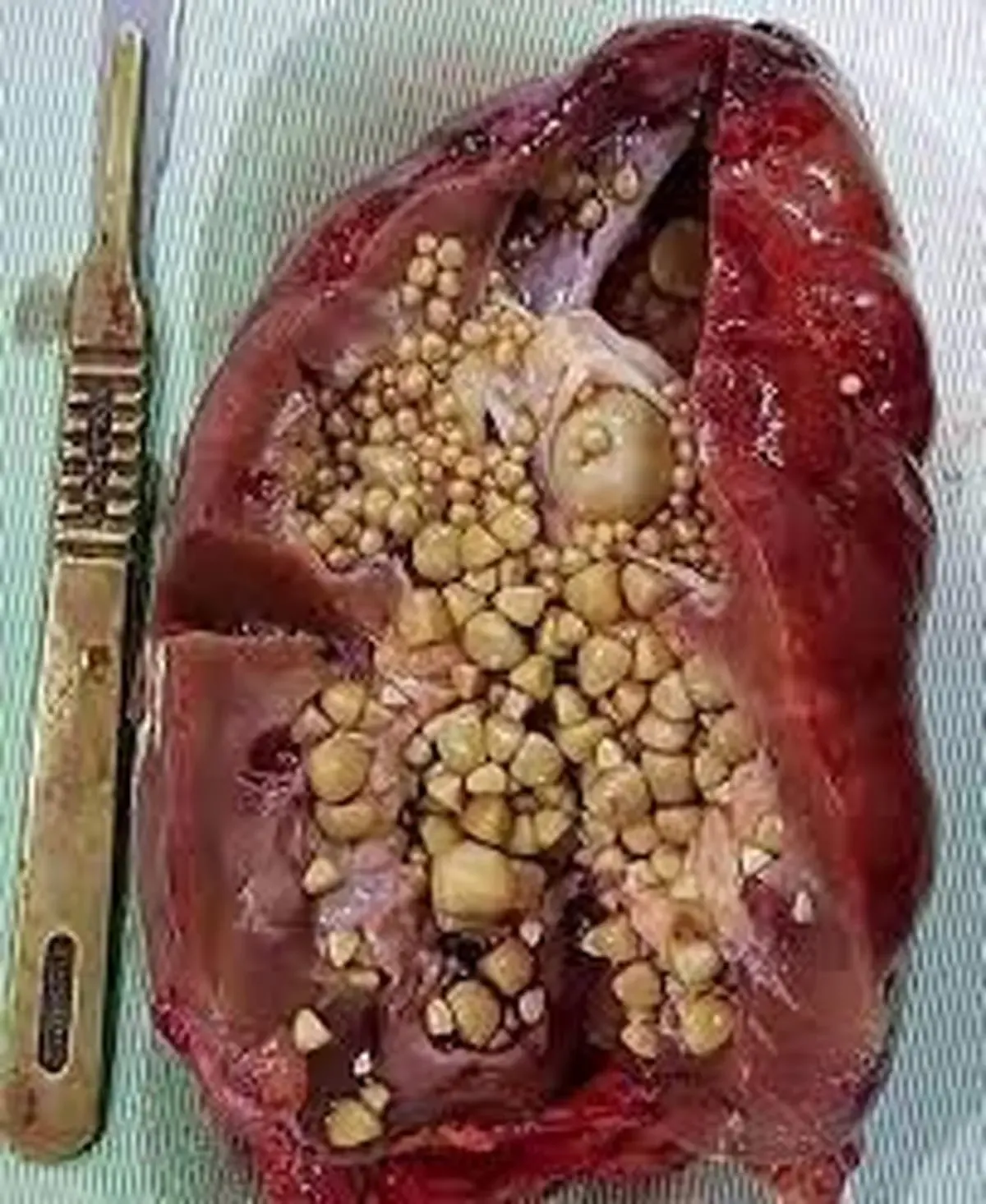 اگر این علائم را دارید کلیه تان سنگ ساز است