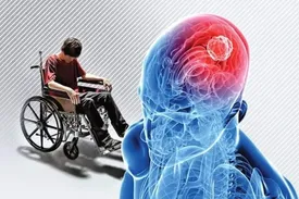 مشکل مثانه از علائم ام اس است؟