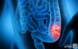 تشخیص دقیق یک سرطان فقط با آزمایش خون